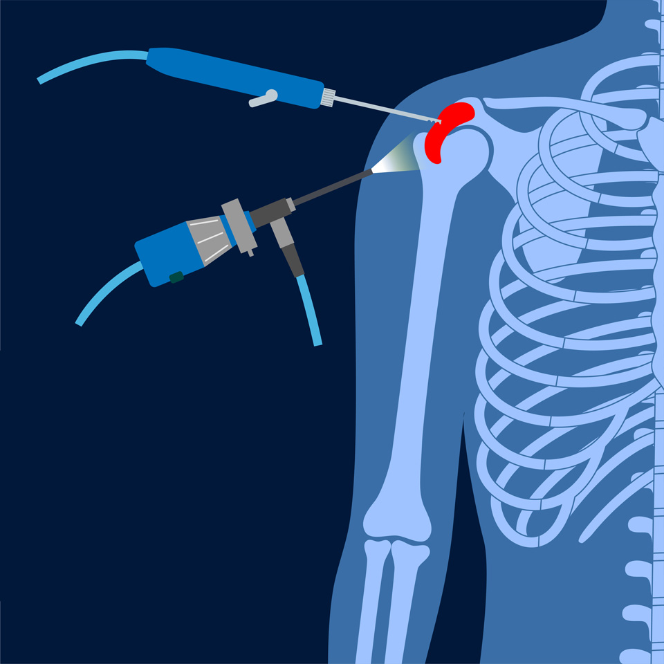 Arthroscopic SLAP repair surgery of the shoulder