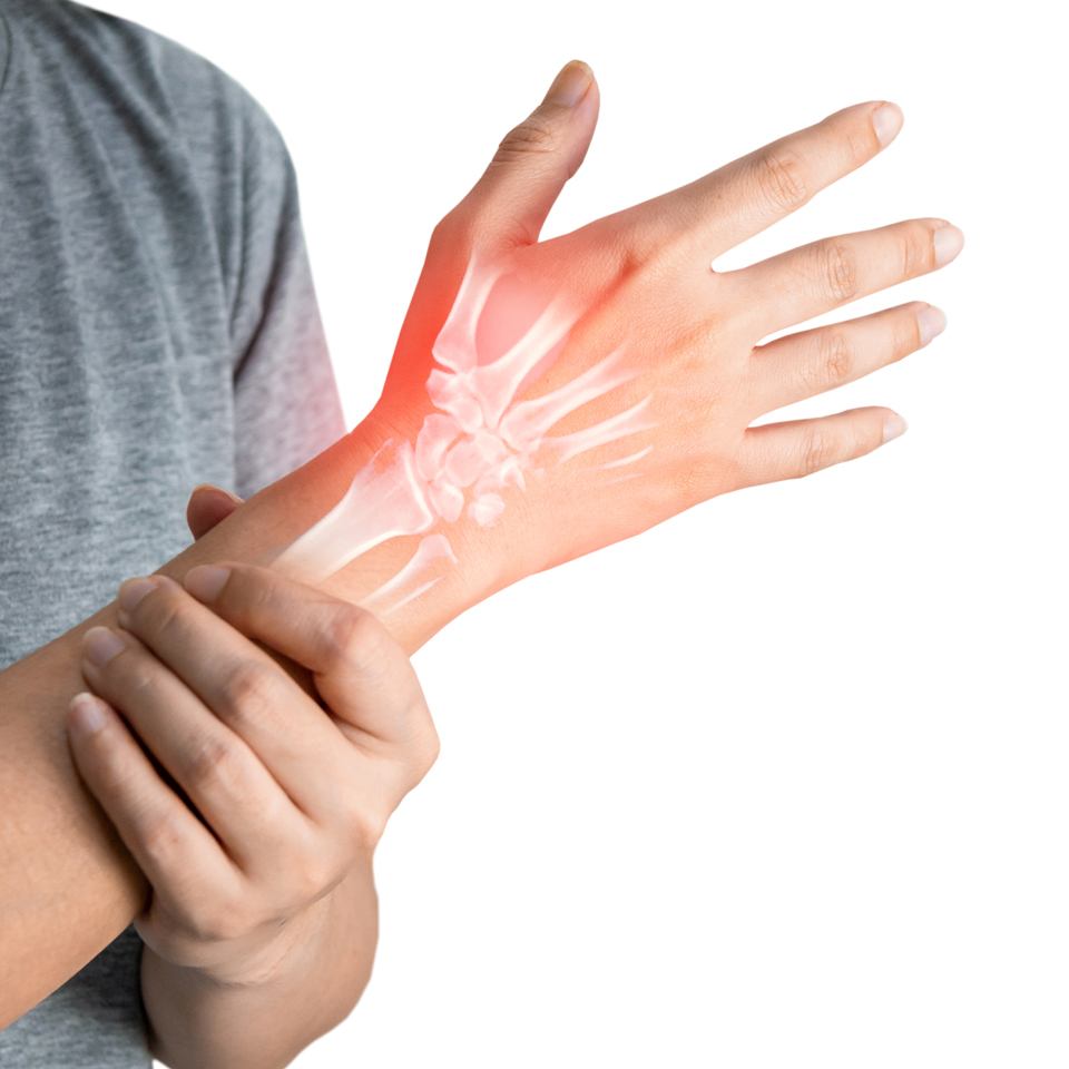 carpal tunnel syndrome