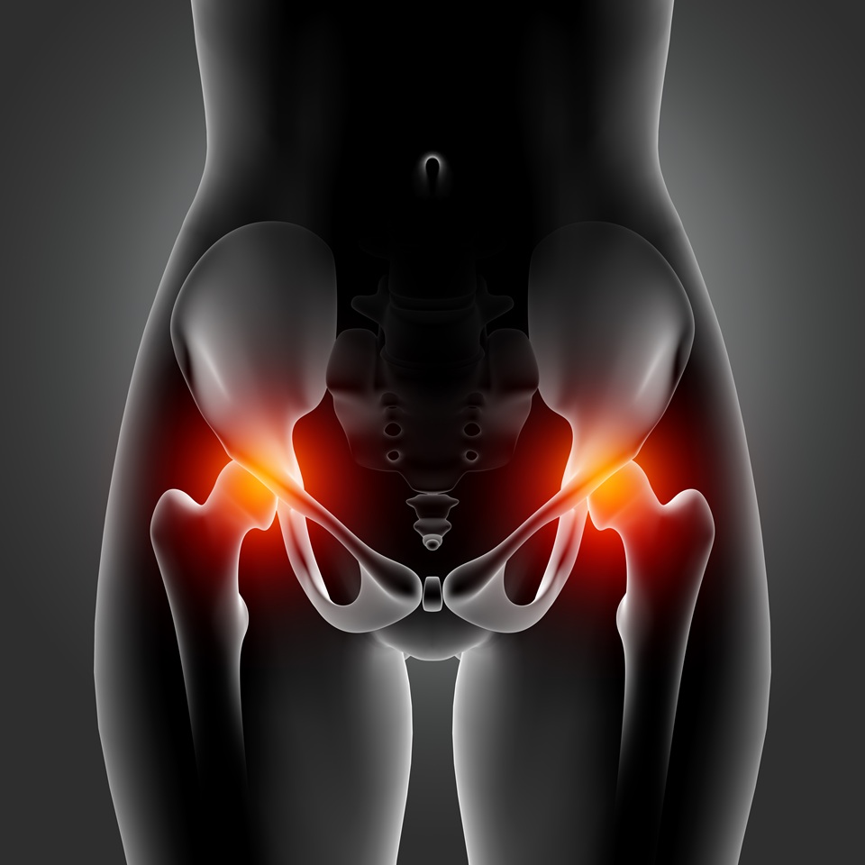 Total Hip Replacement Bone and Joint Consult