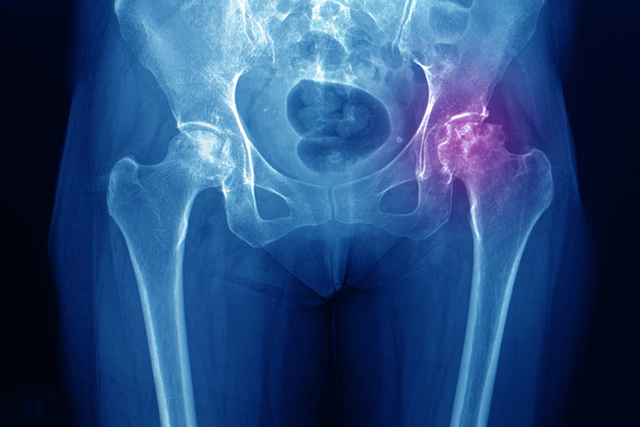 total hip replacement bone and joint consult 